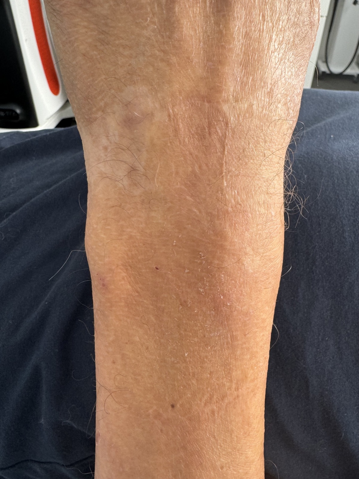 Efter SkinPen Microneedling-behandling