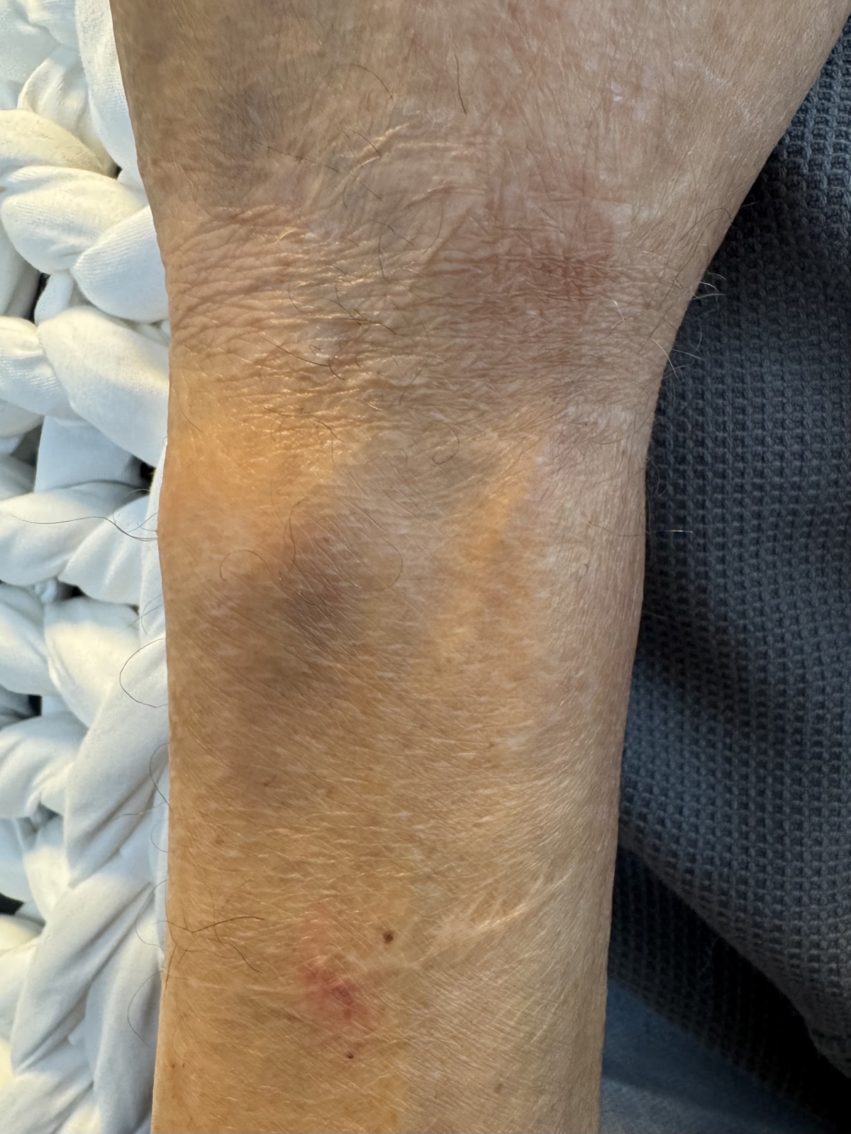 Før SkinPen Microneedling-behandling